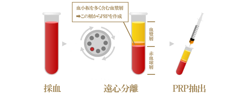 PRP