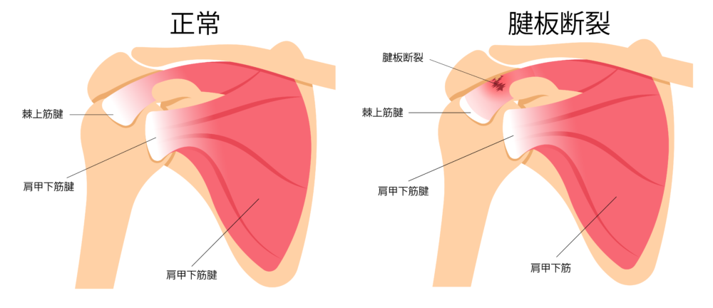 肩腱板断裂