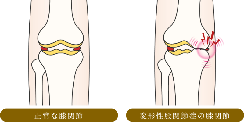 変形性膝関節症の図