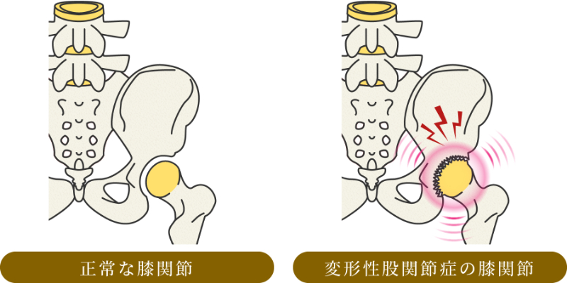 変形性腰椎症