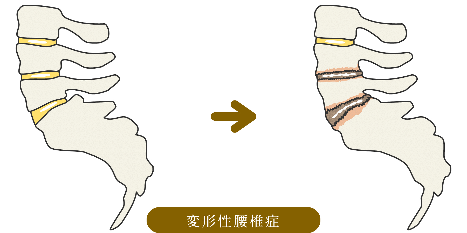 変形性腰椎症のイメージ図