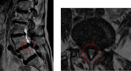 術前MRI_4615