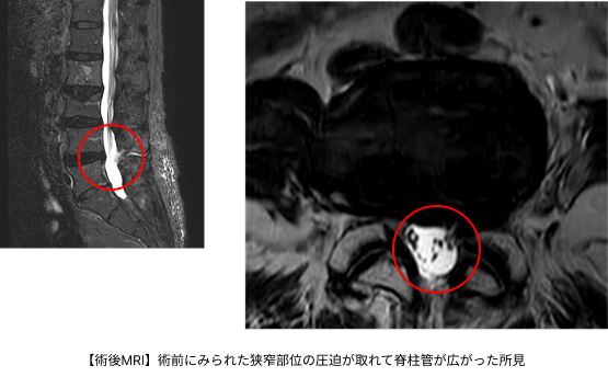 4474術後MRI