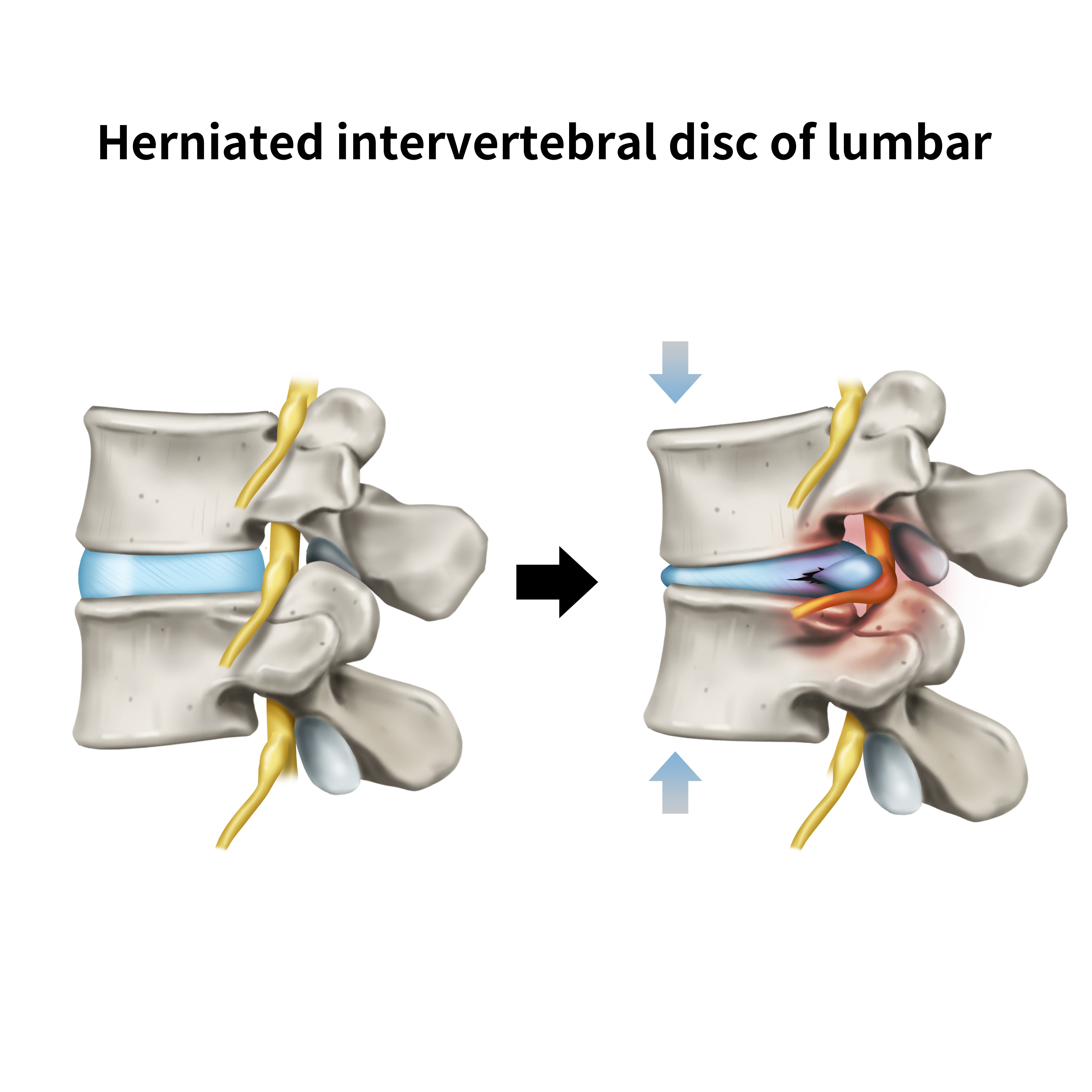 Can a Herniated Disc Recur? Warning Signs After Treatment and How to Prevent Relapse