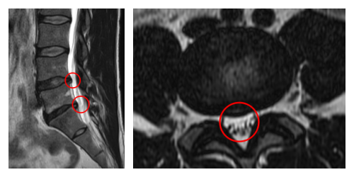 術前MRI_2487