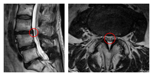 術前MRI