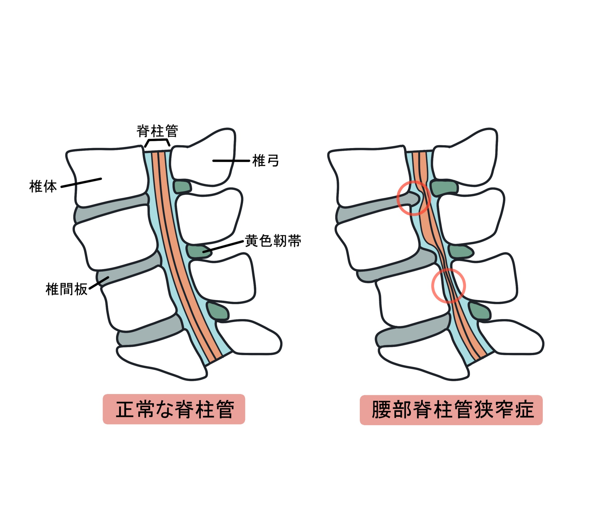 脊柱管狭窄症のイメージ図
