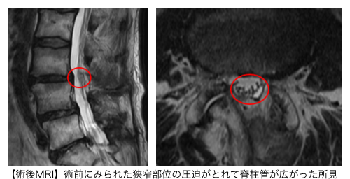 術後MRI