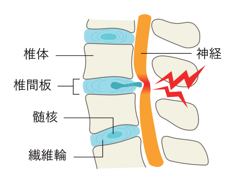 椎間板ヘルニアの図