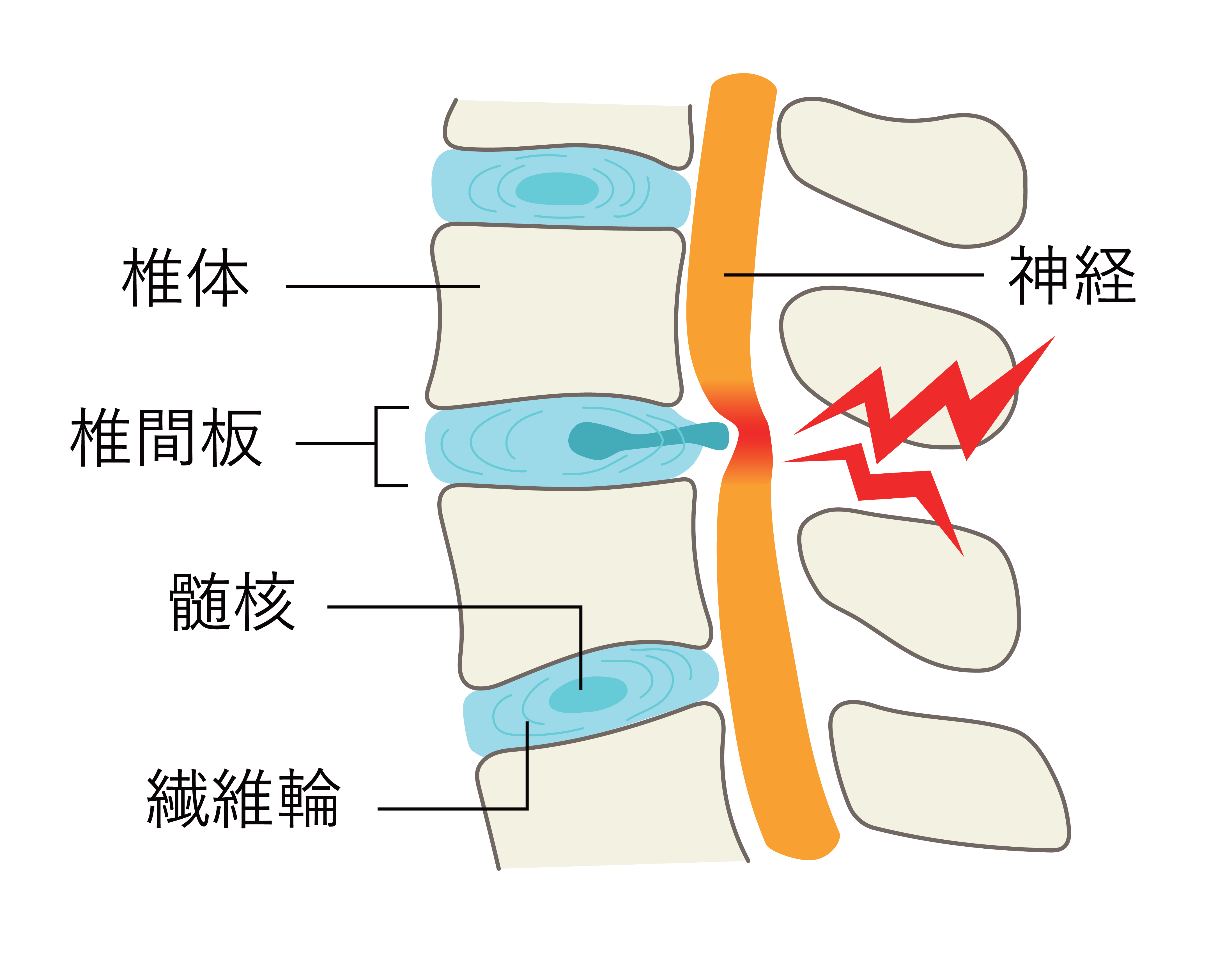 椎間板ヘルニアの図