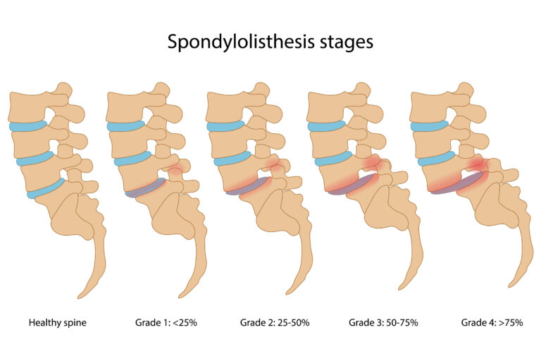 Spondylolisthesis stages