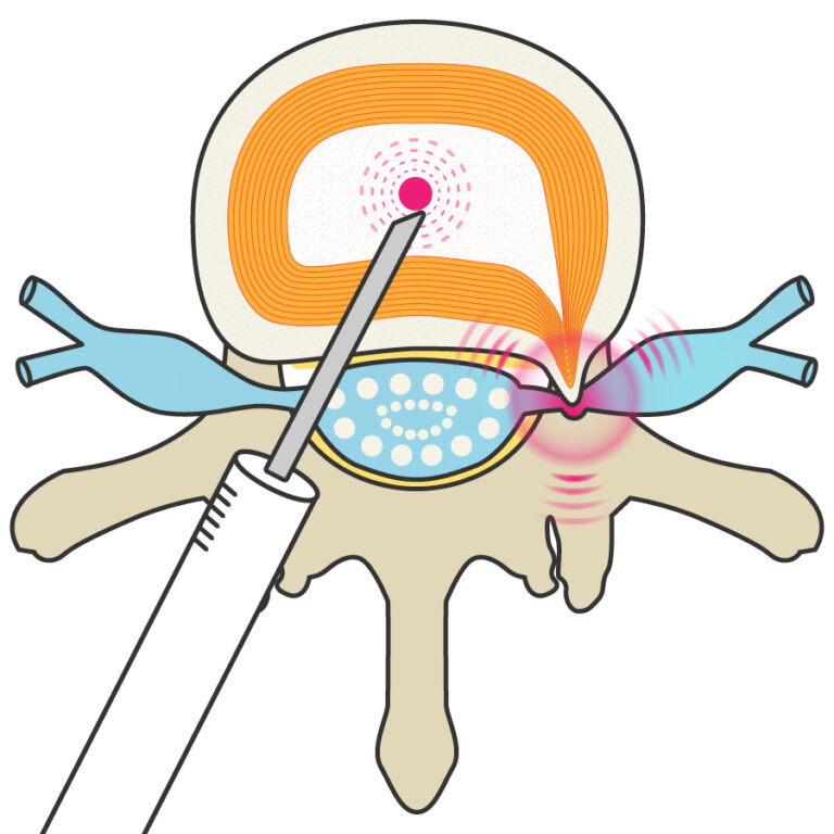 注入のイラスト