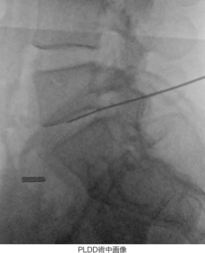 PLDD術中画像
