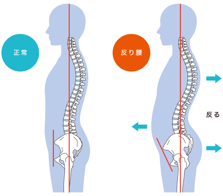 反り腰のイラスト