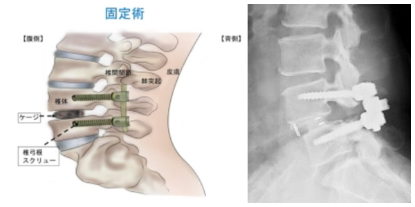 固定術のイメージ