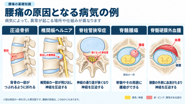 腰痛の原因となる疾患
