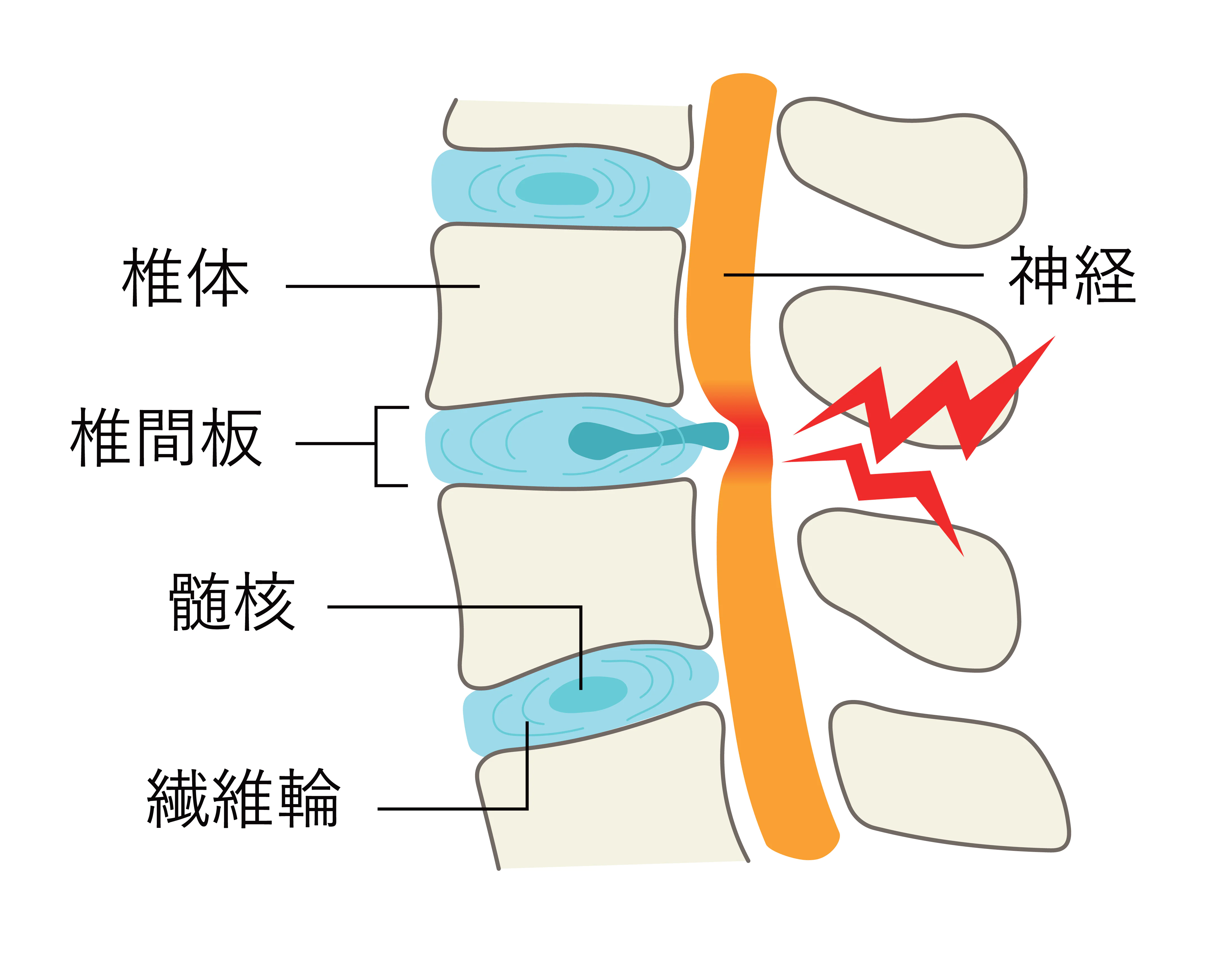 椎間板修復治療