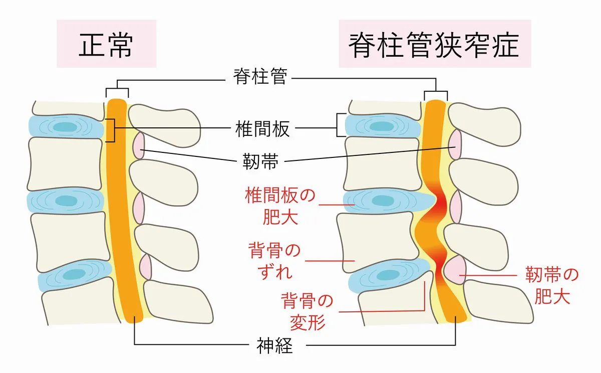 腰部脊柱管狭窄症とは