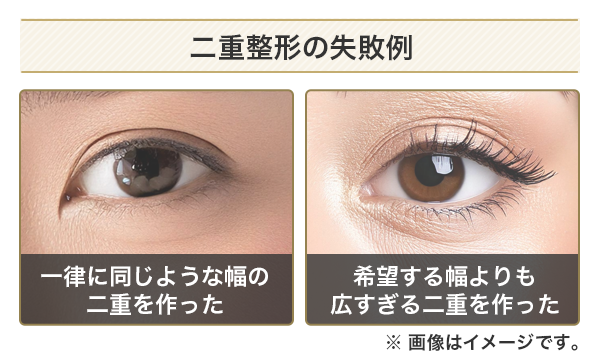 二重整形で失敗するリスクのひとつ、二重線が不自然に太くなったりくっきりしすぎたりしてしまう例