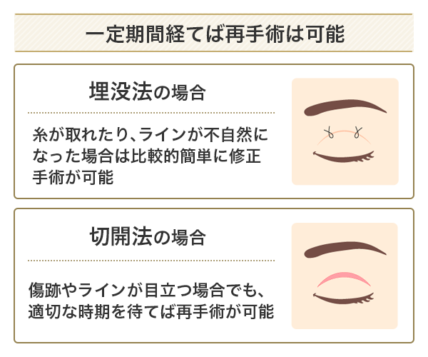 埋没法と切開法の再手術が可能なケース