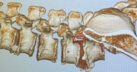 PED (経皮的内視鏡下椎間板摘出術) 東京都渋谷区の表参道総合医療クリニック