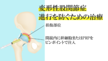 中高年の方、歩けなくなる前に！変形性股関節症で「手術を避けるため」に行うべき治療法とは？