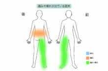 40代男性の腰痛と右足のしびれを日帰り腰痛手術「PLDD（経皮的レーザー椎間板減圧術）」で治療した症例