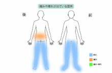 90代女性「腰痛と歩けないほどの痺れを日帰り手術『PEL（脊柱管狭窄症内視鏡下術）』で治療した症例」