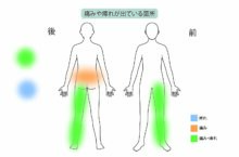40代男性「椎間板ヘルニア手術後に悪化した腰痛を再生医療を使った『PDR法（経皮的椎間板再生治療）』で治療した症例」