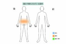 40代男性「腰痛が酷くて大会に出られない」椎間板の損傷を再生医療『PDR（経皮的椎間板再生治療）』で治療した症例