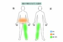 80代女性「腰痛と右足の痛みと痺れで5分も歩けない」高度脊柱管狭窄症を日帰り手術×再生医療で治療した症例