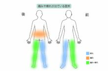 60代男性「20年間悩んだ腰痛が悪化、足が固まったように痺れて痛い」椎間板ヘルニアを日帰り手術×再生医療で治療した症例