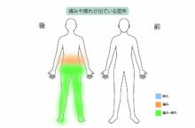 60代男性「脊柱管狭窄症再発で歩行障害も」日帰り手術×再生医療で治療した症例