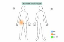 60代男性「左お尻が痛い」椎間板ヘルニアを日帰り手術と再生医療で治療した症例