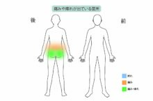 80代女性「腰痛が酷くて歩けない」脊柱管狭窄症を日帰り手術×再生医療で治療した症例