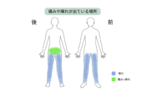 【症例紹介】椎間板ヘルニア手術後に痛みと痺れが残り、PELとPRP療法を行った50代男性の症例
