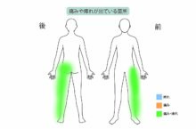 【症例紹介】右側下半身の痛みと痺れ、脊柱管狭窄症を「PEL（脊柱管狭窄症内視鏡下術）」と再生医療「PRP療法」で治療した80代男性