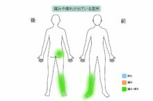 【症例紹介】右足に痛みと痺れ、すべり症に伴う脊柱管狭窄症を『日帰り手術「PEL」×再生医療「PRP療法」』で治療した70代女性