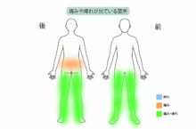 【症例紹介】歩行時の腰痛の原因”脊柱管狭窄症”を『日帰り手術「PEL」×再生医療「PRP療法」』で治療した80代男性