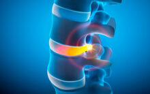 PLDDとは？椎間板ヘルニアにレーザーを照射して症状改善を目指す治療法