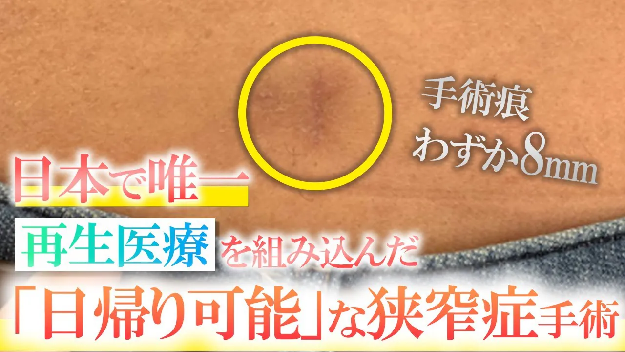 「日帰り」で内視鏡手術ができる‼、狭窄症の進行と再生医療を組み合わせた治療法とは？